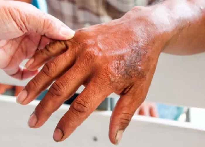  La lepra no ha desaparecido en Casanare, esté alerta a los sintomas